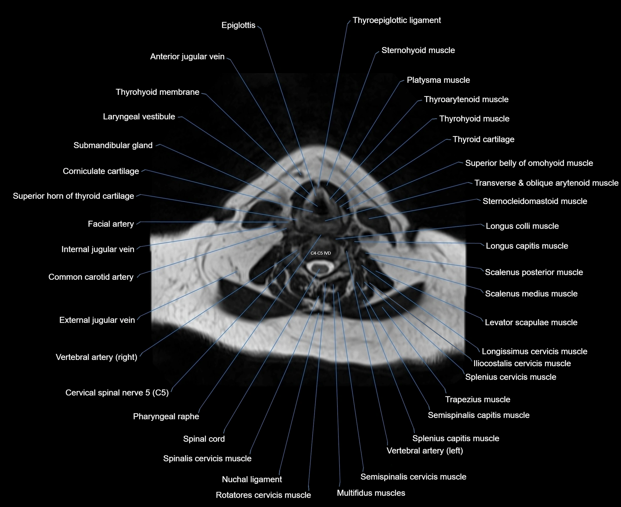 MRI Neck 3D labelled cross section anatomy axial 3t image-00001-00057.webp